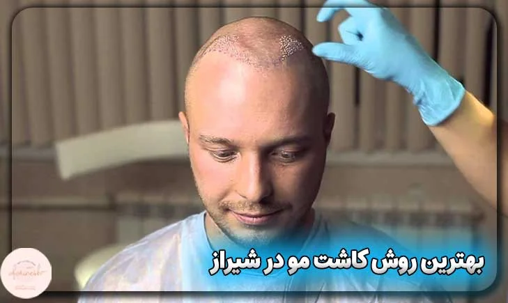 بهترین روش کاشت مو در شیراز