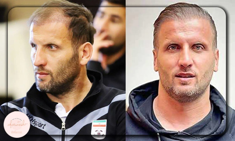 عکس قبل و بعد کاشت مو محسن بنگر