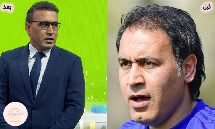عکس قبل و بعد کاشت مو مهدوی کیا