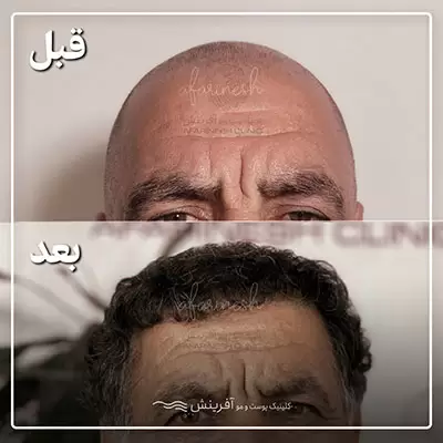 قبل و بعد از کاشت مو