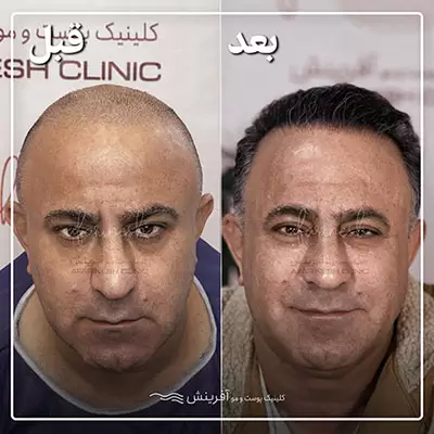 قبل و بعد از کاشت مو