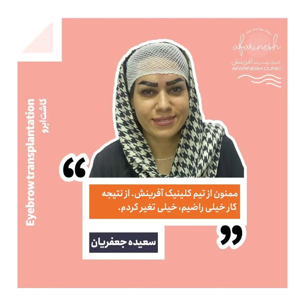 نظرات کسانی که کاشت ابرو انجام داده اند