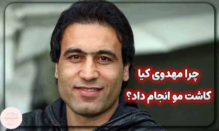 چرا مهدوی کیا کاشت مو انجام داد؟