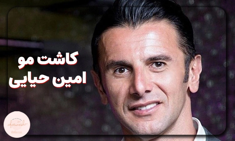 امین حیایی قبل از کاشت مو