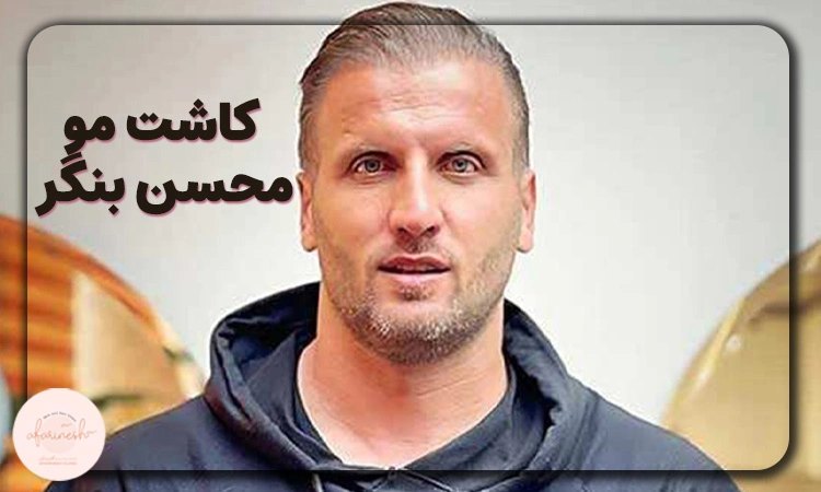 کاشت مو محسن بنگر