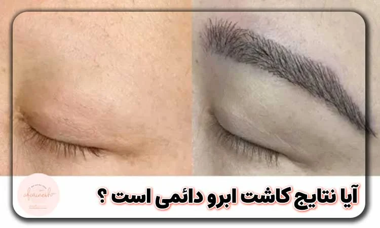 آیا نتایج کاشت ابرو دائمی است