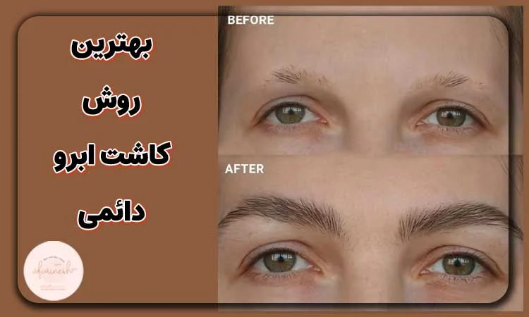بهترین روش های کاشت ابرو برای نتایج دائمی