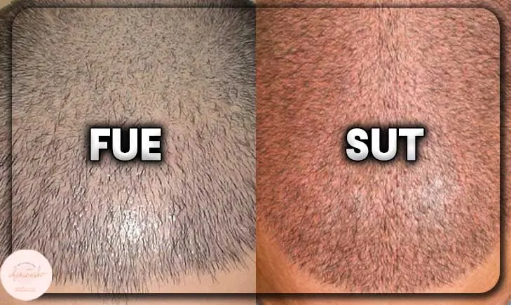 تفاوت کاشت مو به روش sut و fue