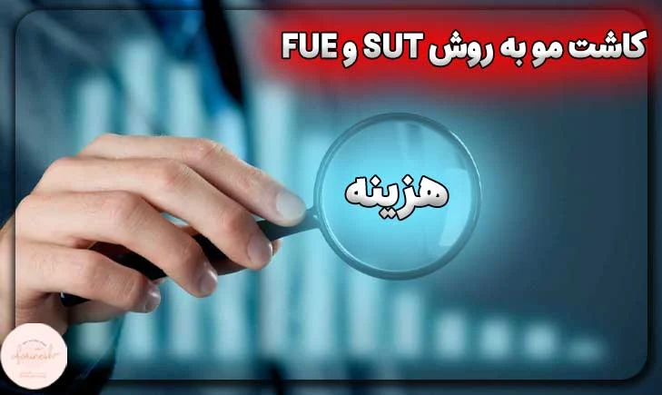 تفاوت کاشت مو به روش sut و fue از نظر هزینه