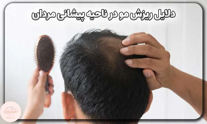 دلایل ریزش مو در ناحیه پیشانی مردان