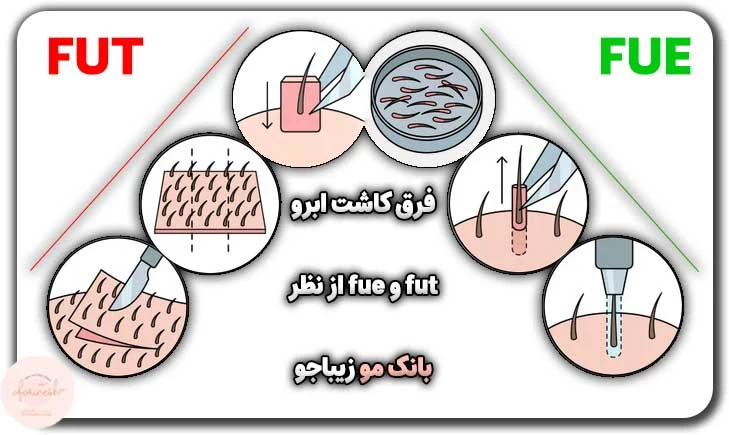 فرق کاشت ابرو fut و fue از نظر بانک مو زیباجو