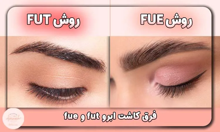 فرق کاشت ابرو fut و fue