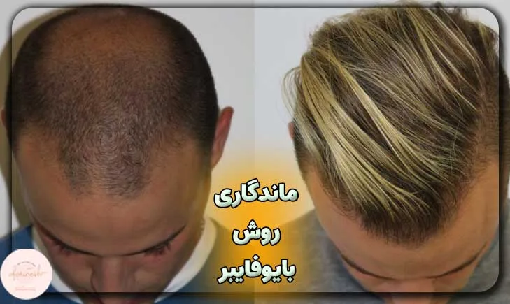 ماندگاری کاشت مو به روش بایوفایبر چگونه است؟