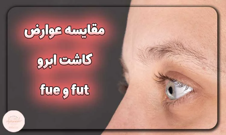 مقایسه عوارض کاشت ابرو fut و fue