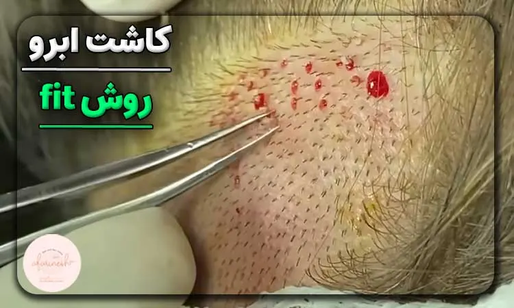 کاشت ابرو به روش fit