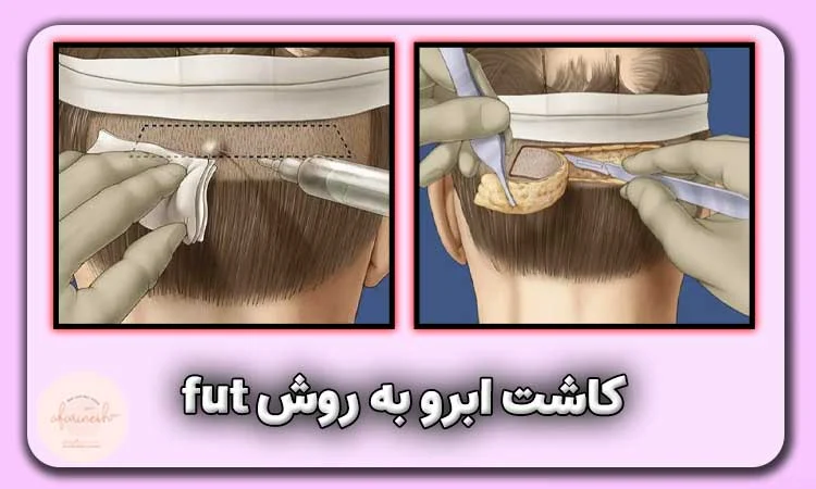 کاشت ابرو به روش fut