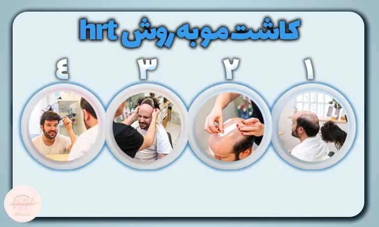 کاشت مو HRP چطور انجام می شود