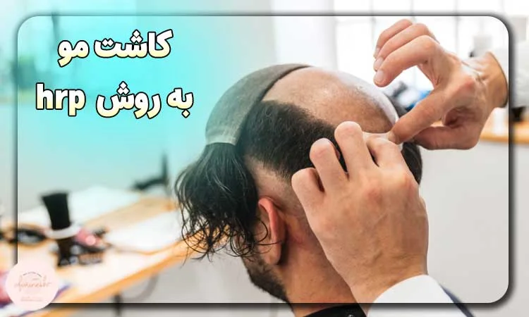 کاشت مو به روش hrp