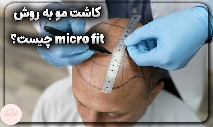 کاشت مو به روش micro fit چیست؟