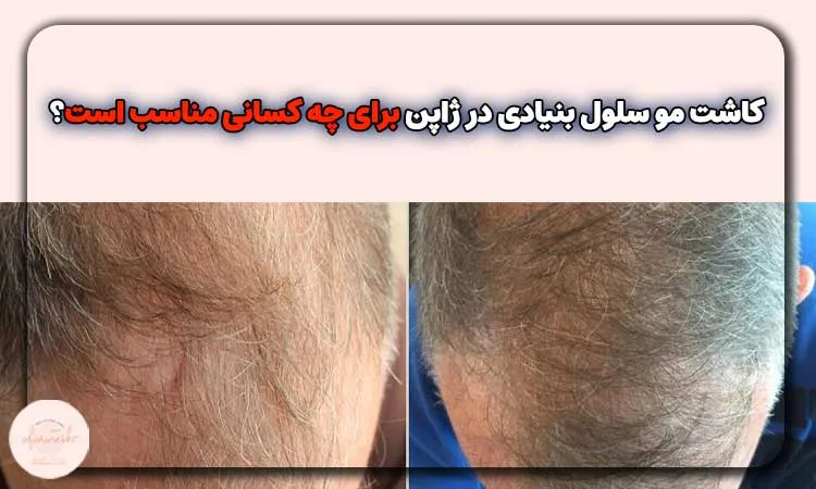 کاشت مو سلول بنیادی در ژاپن برای چه کسانی مناسب است؟