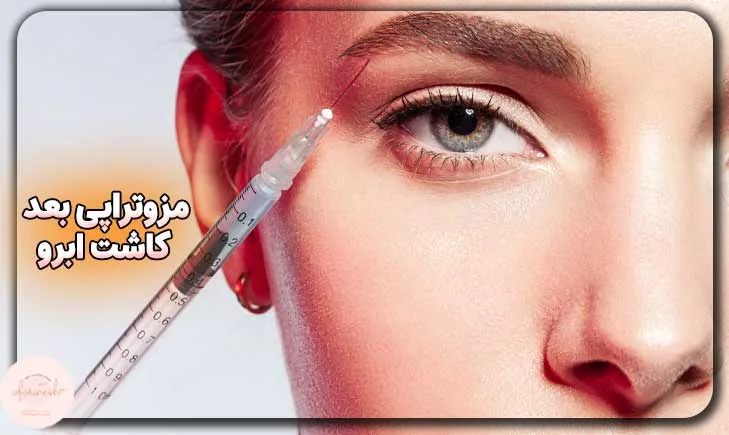 آیا مزوتراپی بعد از کاشت ابرو باعث تقویت ابرو می شود؟