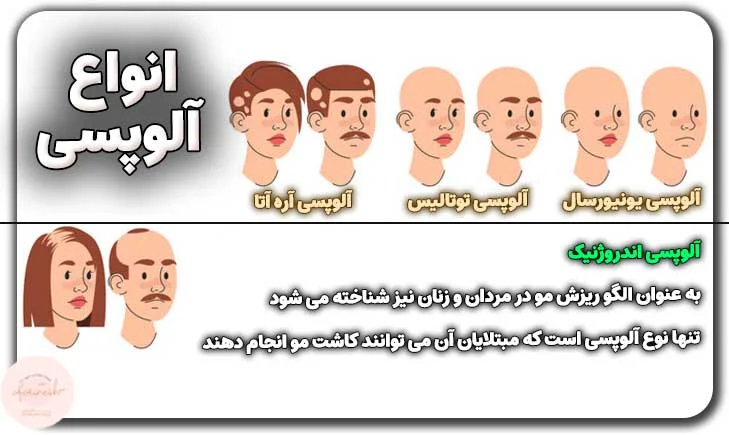 انواع آلوپسی برای کاشت مو