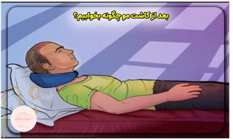 بعد از کاشت مو چگونه بخوابیم؟