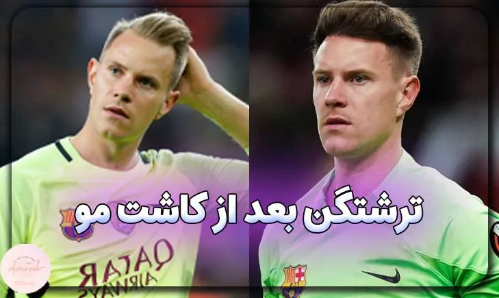 ترشتگن بعد از کاشت مو