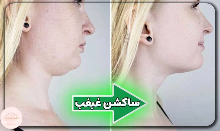 ساکشن غبغب