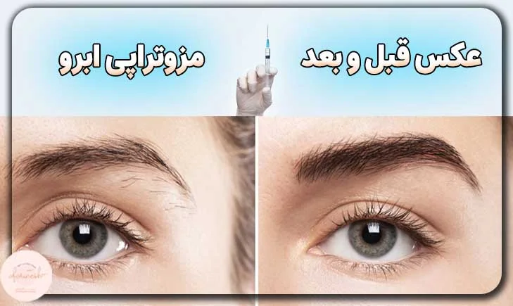 عکس قبل و بعد از مزوتراپی ابرو