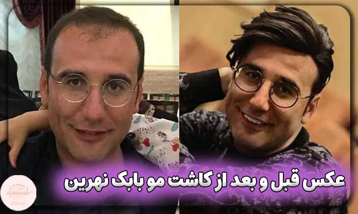 عکس قبل و بعد از کاشت مو بابک نهرین