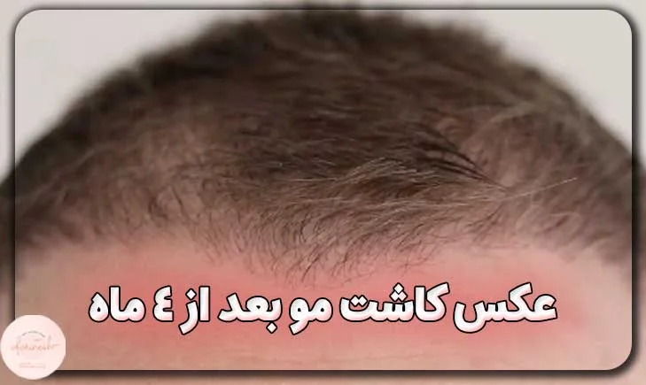 عکس کاشت مو بعد از 4 ماه