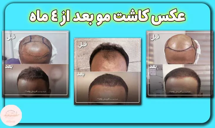 عکس کاشت مو بعد از 4 ماه