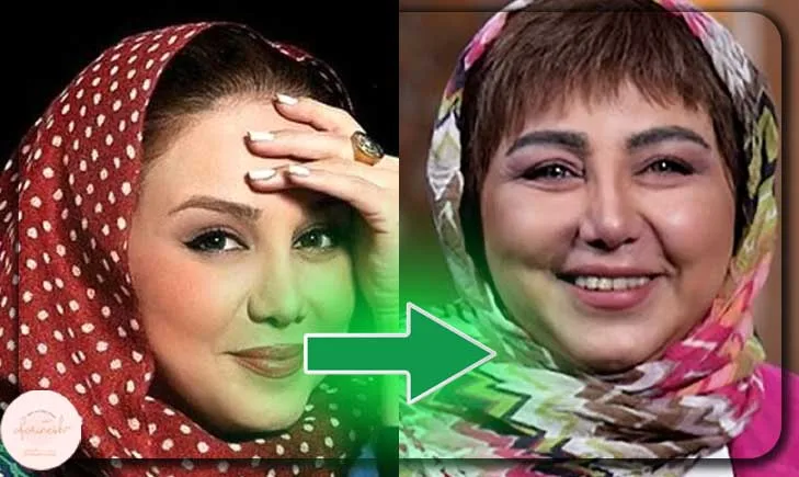 عکس کاشت مو بهنوش بختیاری