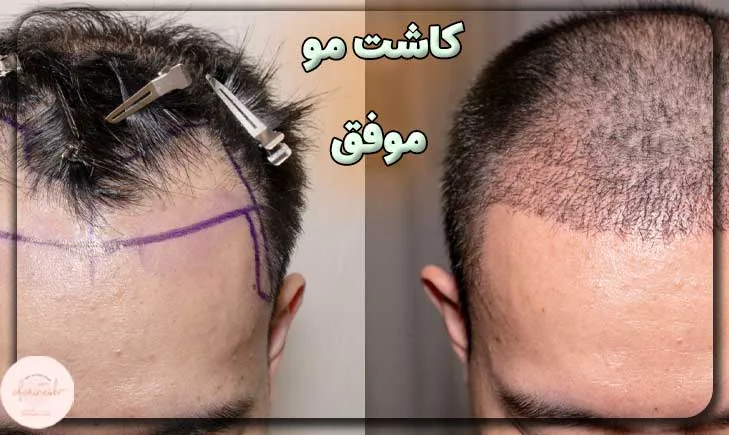 عکس کاشت مو موفق