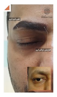 تصاویر کاشت ابرو