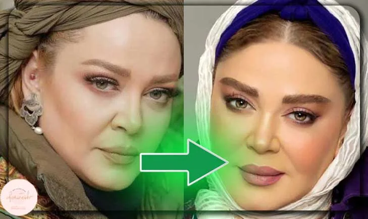قبل و بعد از کاشت مو بهاره رهنما