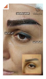 قبل و بعد از کاشت ابرو