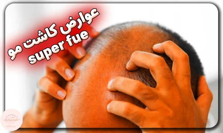 معایب کاشت مو به روش Super FUE