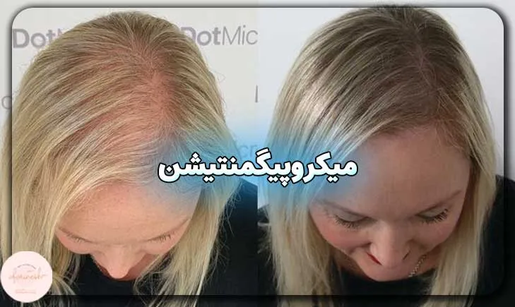 میکروپیگمنتیشن