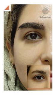 تصاویر کاشت ابرو