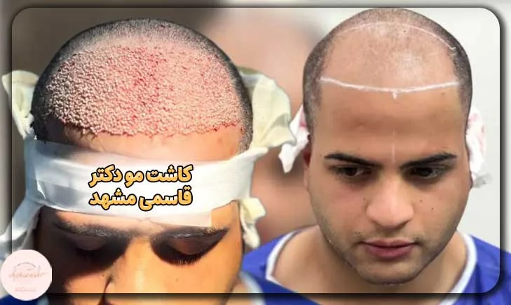 نمونه کار های کاشت مو دکتر قاسمی مشهد