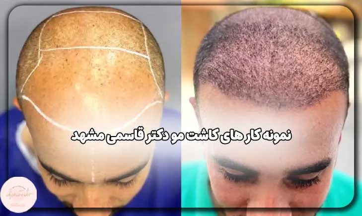 نمونه کار های کاشت مو دکتر قاسمی مشهد