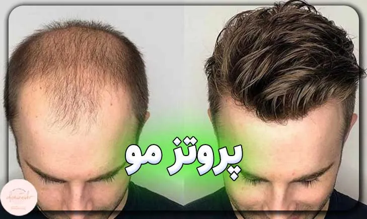 پروتز مو