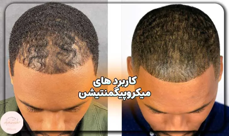 کاربرد های میکروپیگمنتیشن