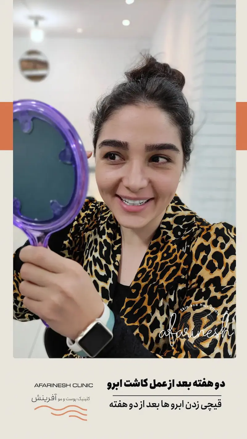نمونه کاشت ابرو در کلینیک آفرینش