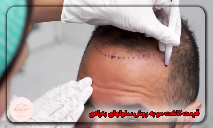 قیمت کاشت مو به روش سلولهای بنیادی​