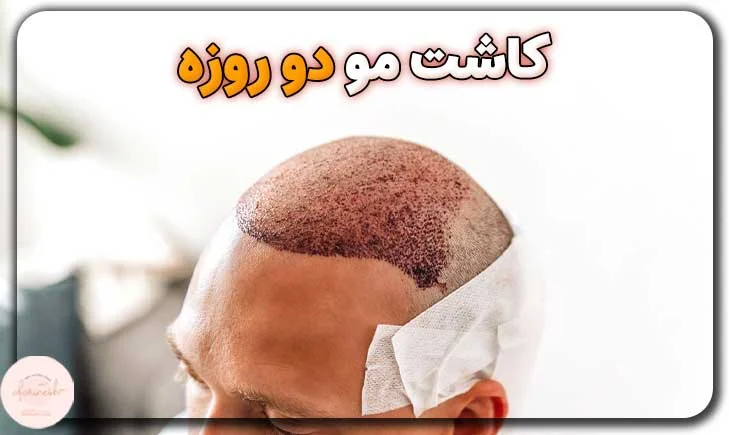 کاشت مو دو روزه
