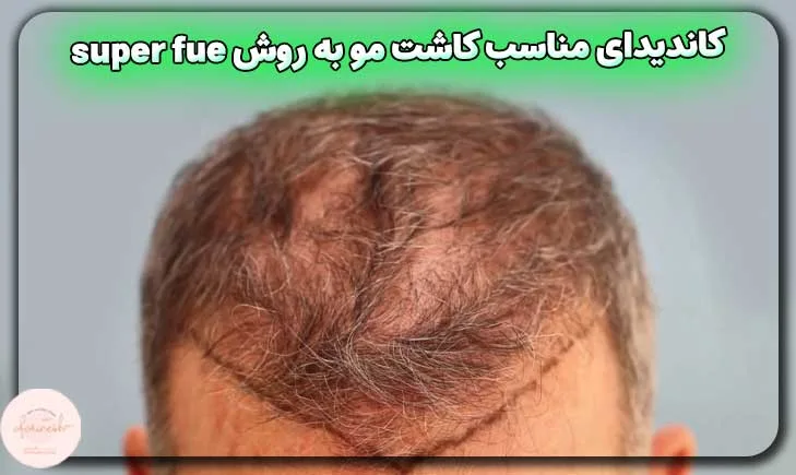 کاندیدای مناسب کاشت مو به روش super fue