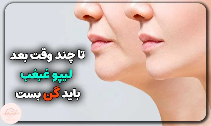 تا چند وقت بعد از لیپو غبغب باید گن بست